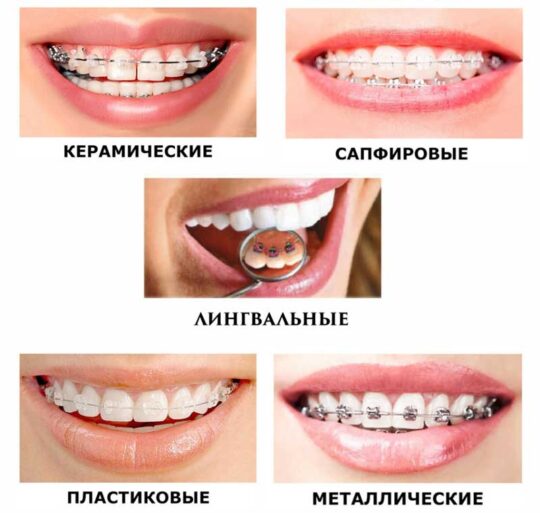 Брекеты у детей фото