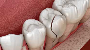 трещина на зубе