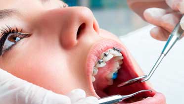 Брекеты после удаления