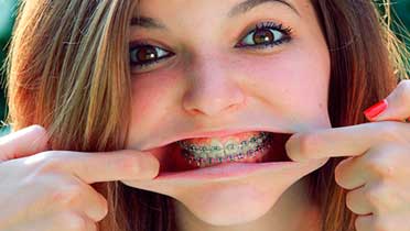 Мифы о брекетах