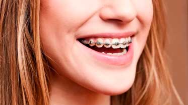 Когда лучше ставить брекеты