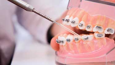 Активация брекетов