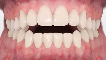 дизоклюзия