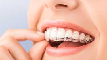 Элайнеры Invisalign