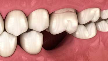 Дентоальвеолярное удлинение