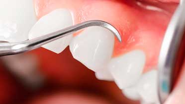 Рецессия десны