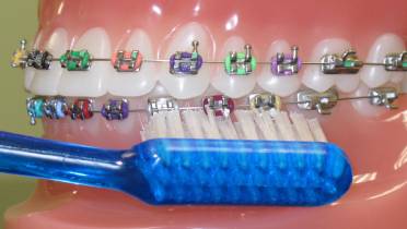 Ортодонтическое кольцо