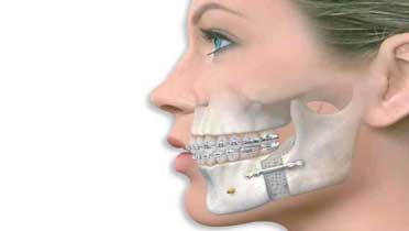 Остеотомия