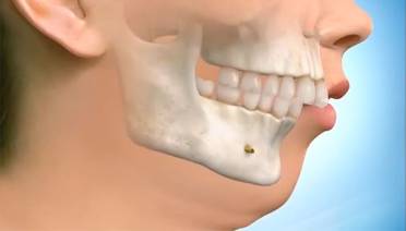 Прогнатия челюстей