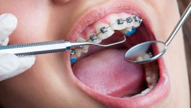 Ортодонтический адгезив