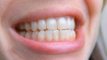 Исправление неправильного прикуса имплантацией