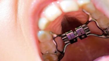 Нёбное расширение