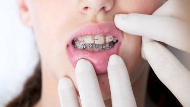 Брекеты натирают щеки