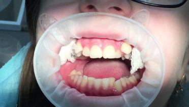 Полиодонтия