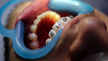 Ортодонтические ретракторы