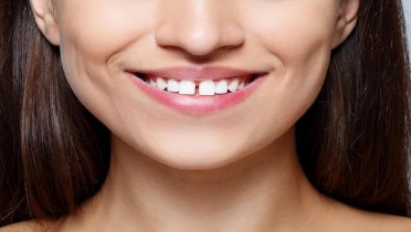 Как закрыть щель между зубами