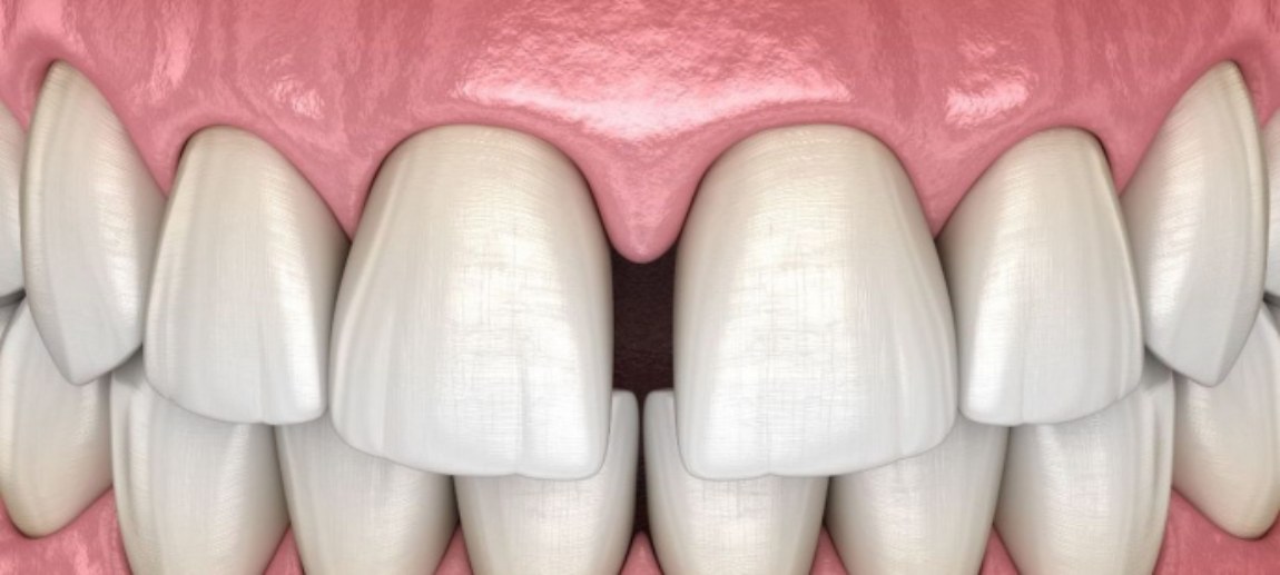 Как закрыть диастему