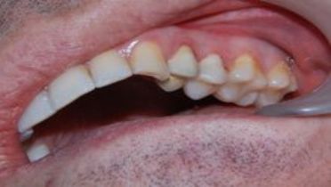 Удаление премоляров в ортодонтии.