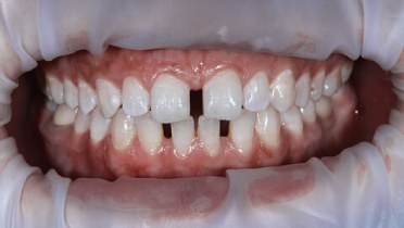 Что такое Тремы