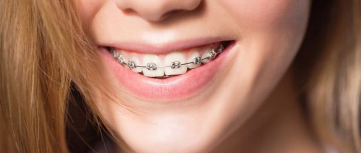 Брекеты и чувствительность зубов