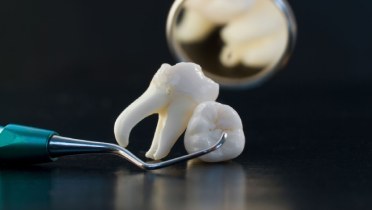 Кариес зуба мудрости: лечить или удалять